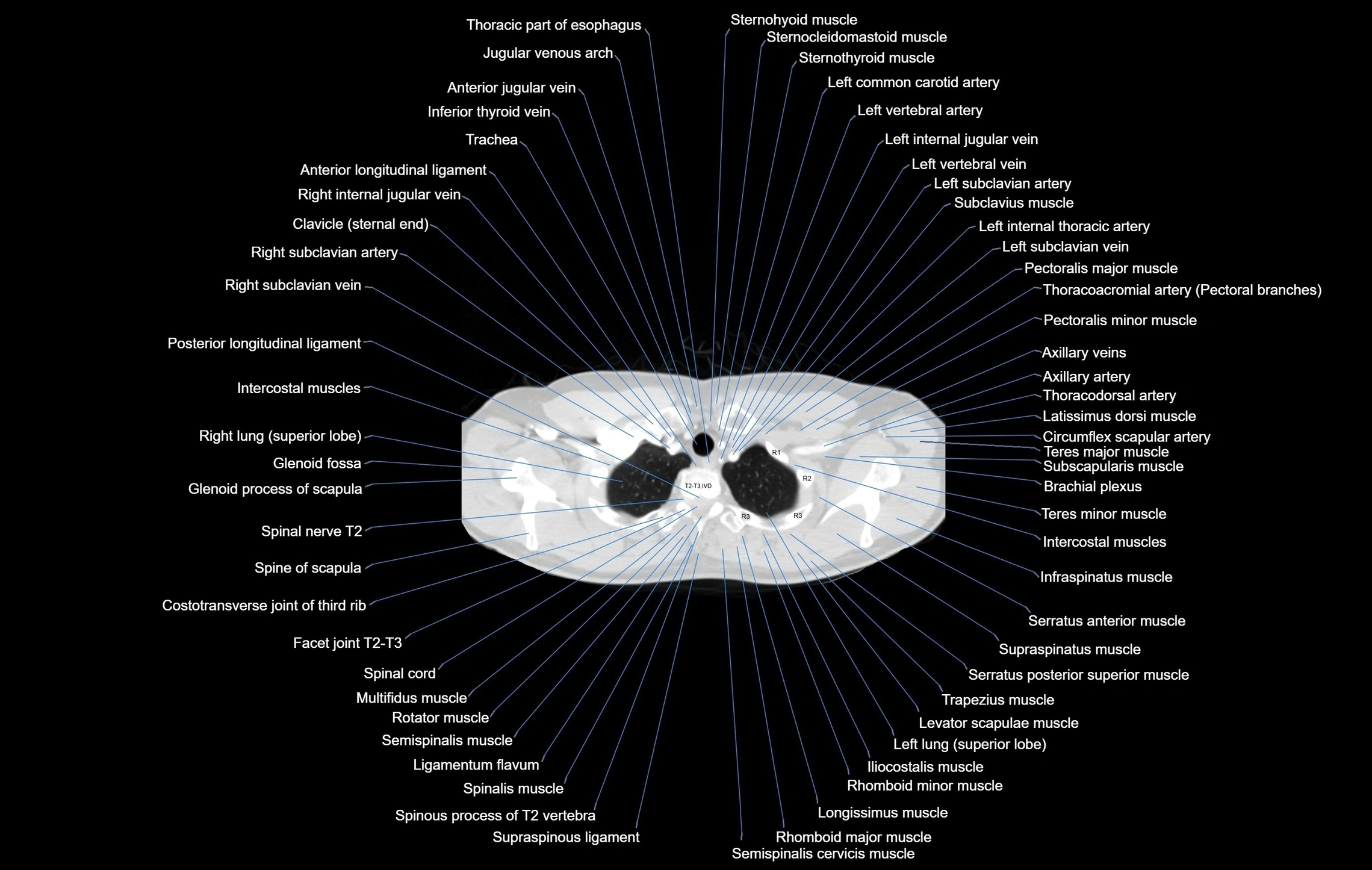 CT chest (thorax) labelled axial cross sectional anatomy radiology image-00013.webp